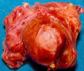 PRIMARY ADRENAL LEIOMYOSARCOMA