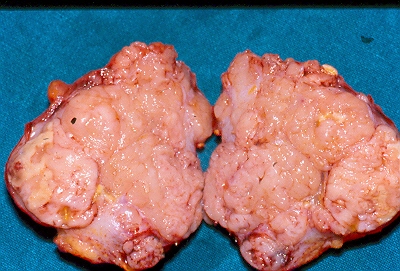 PRIMARY ADRENAL LEIOMYOSARCOMA