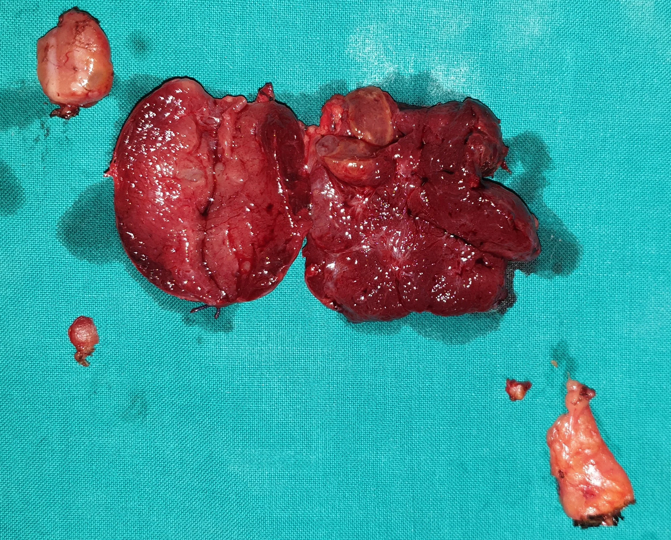 PARATHYROID ADENOMA