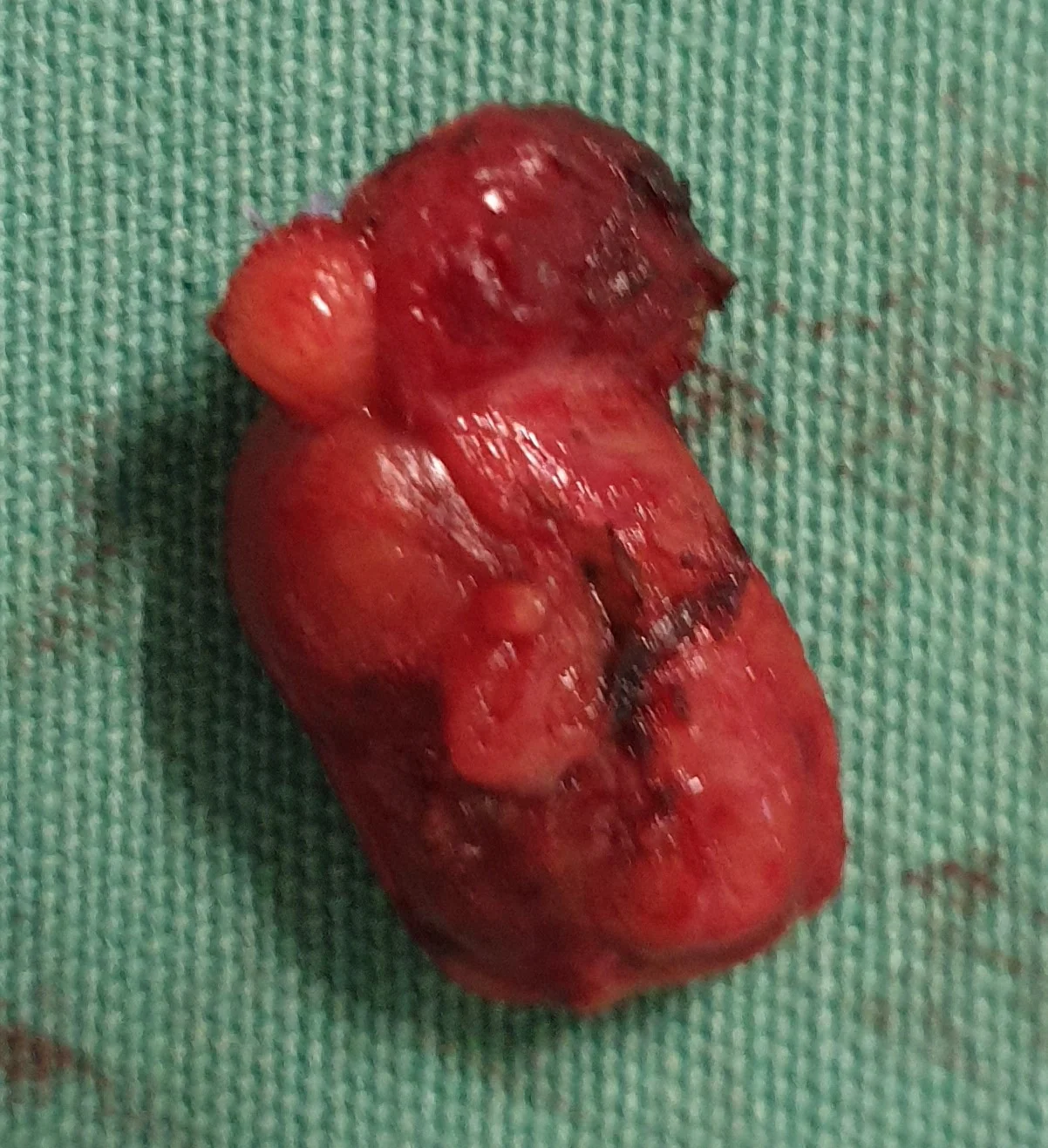 PARATHYROID ADENOMA