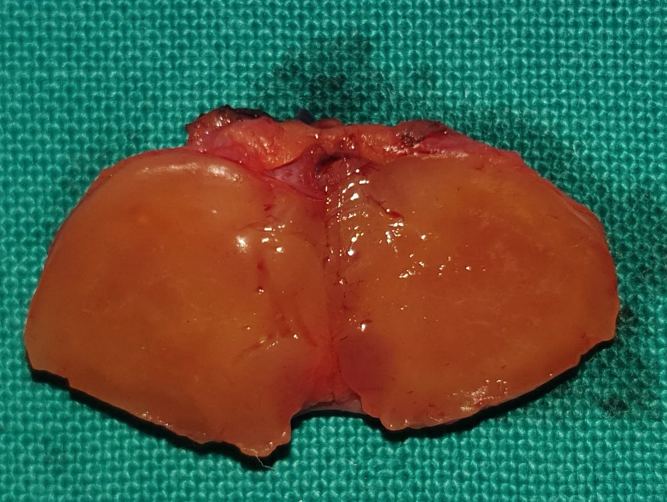 PARATHYROID ADENOMA