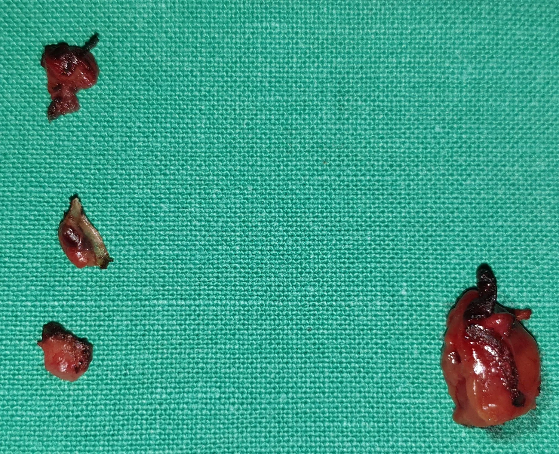 TOTAL PARATHYROIDECTOMY