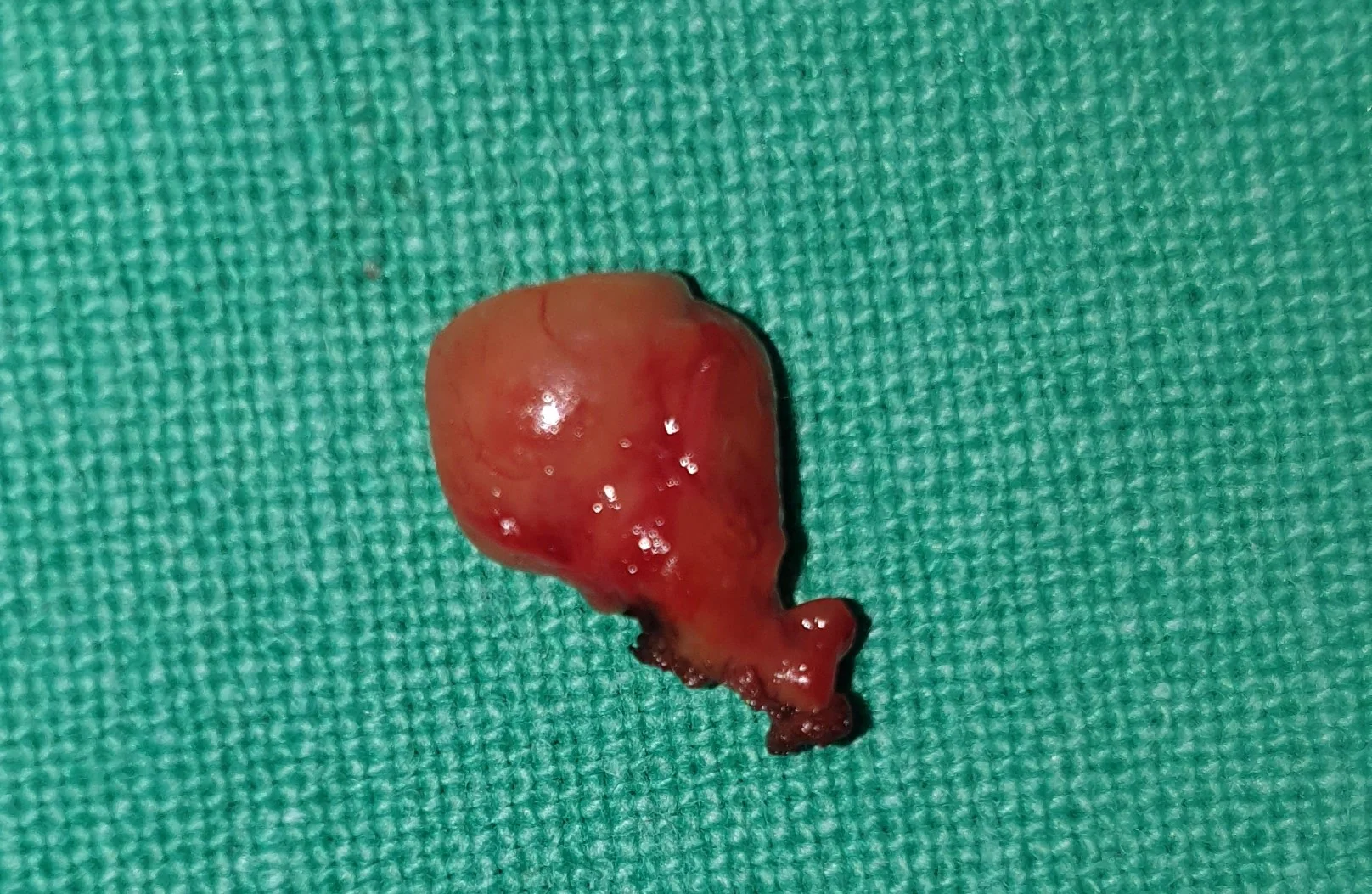 PARATHYROID ADENOMA