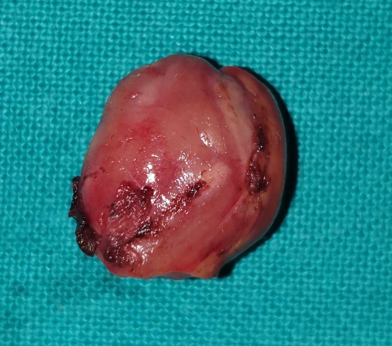 PARATHYROID ADENOMA