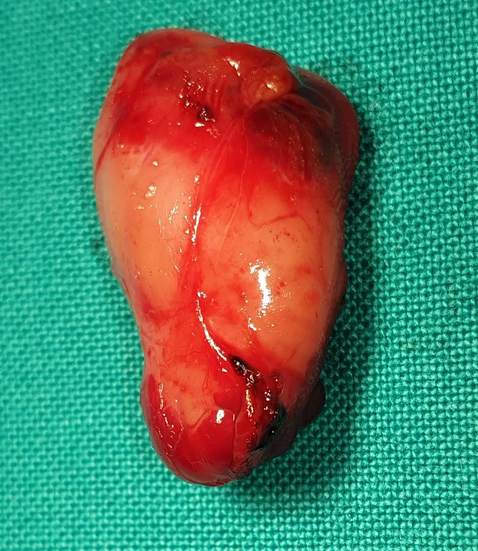 PARATHYROID ADENOMA