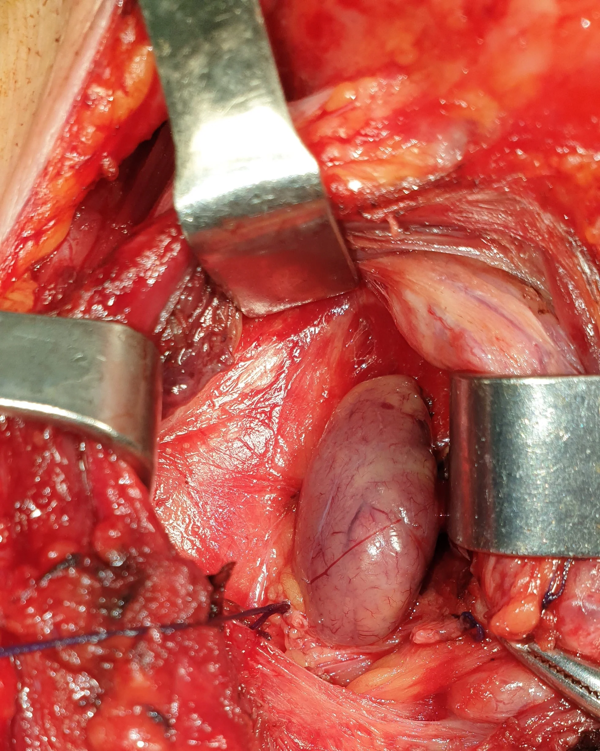 PARATHYROID ADENOMA