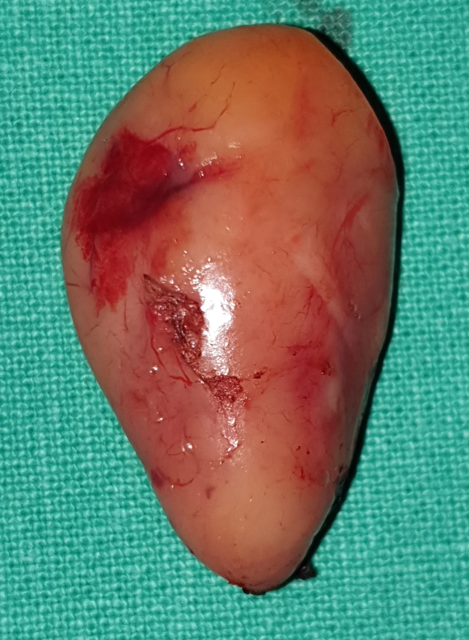 PARATHYROID ADENOMA