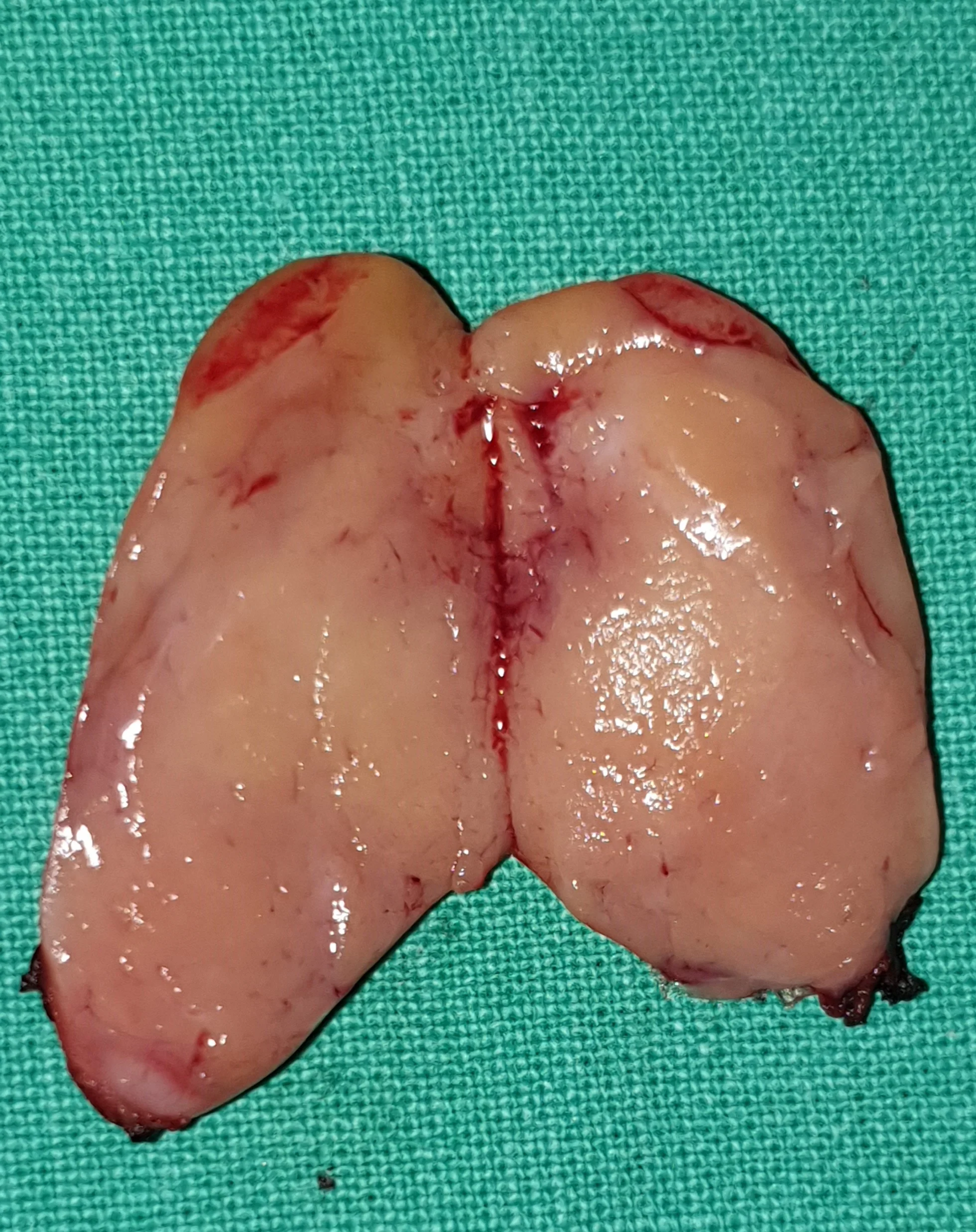 PARATHYROID ADENOMA