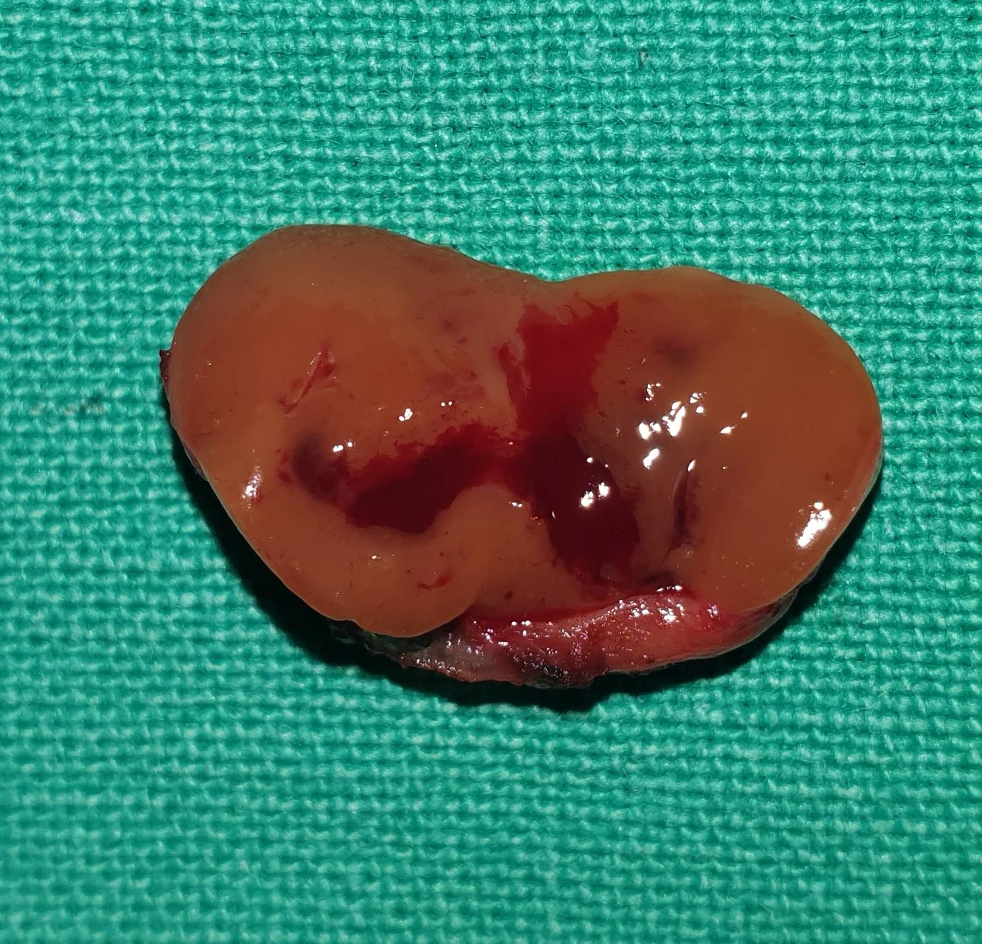 PARATHYROID ADENOMA