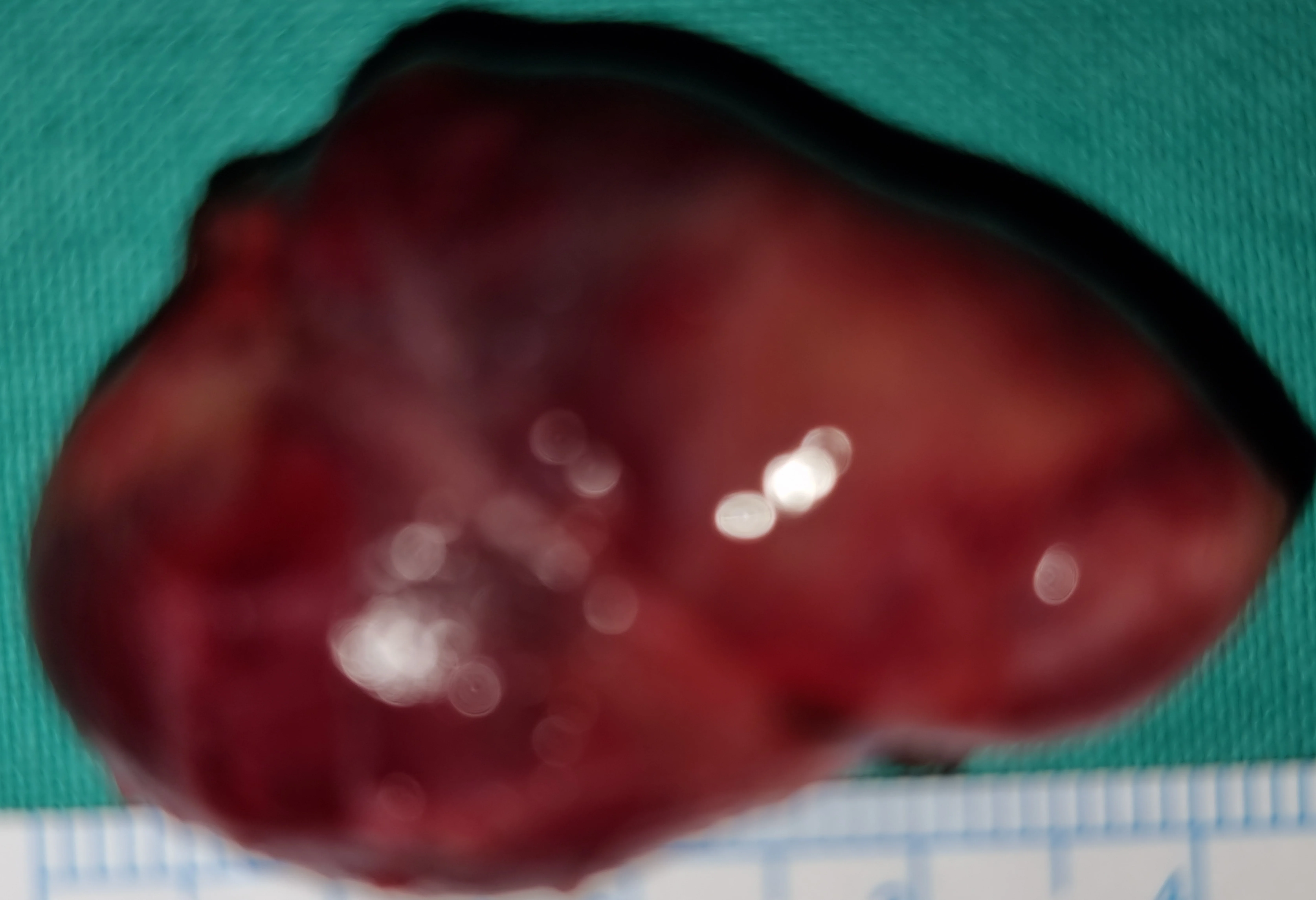 PARATHYROID ADENOMA