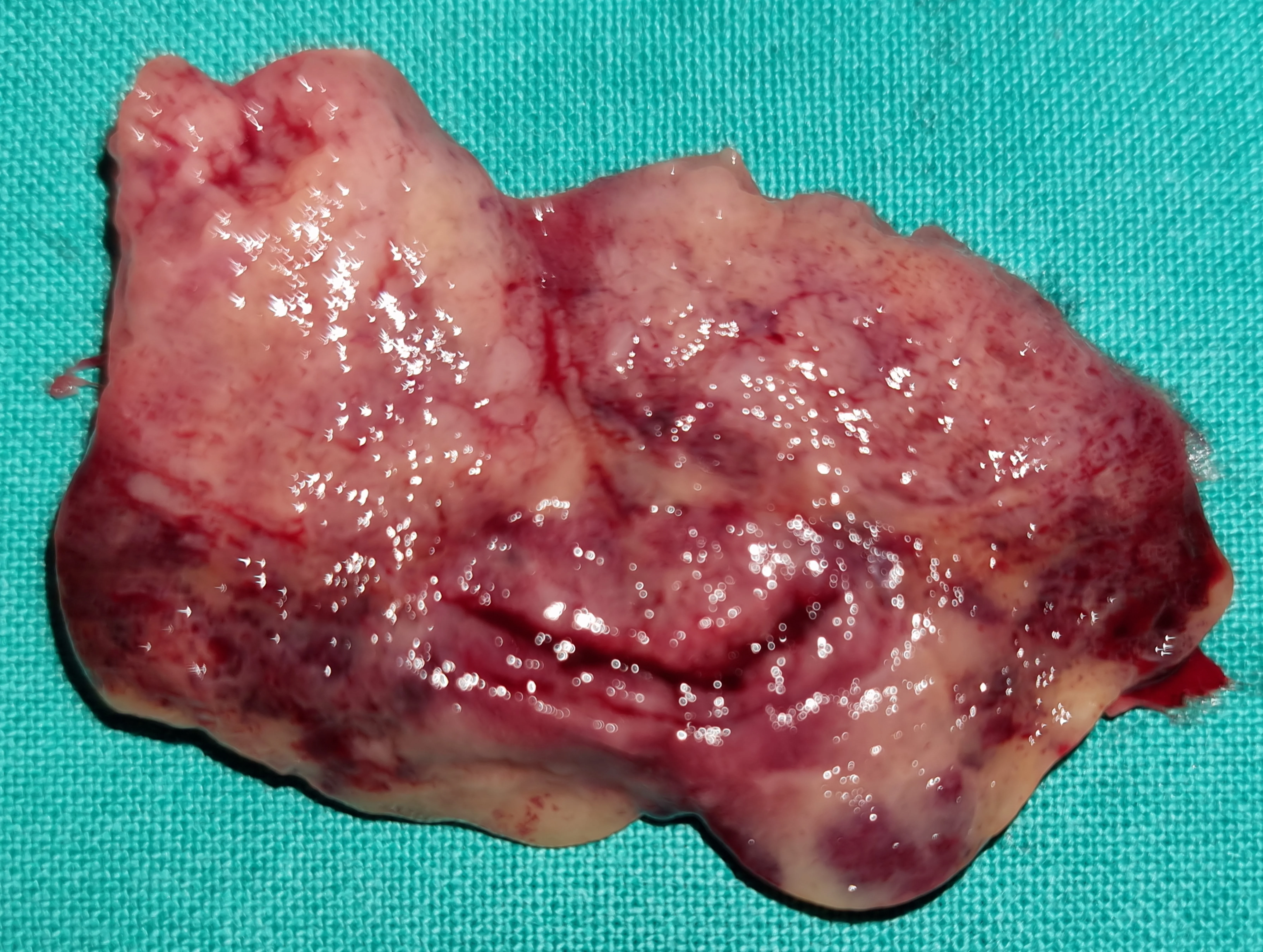 PARATHYROID ADENOMA