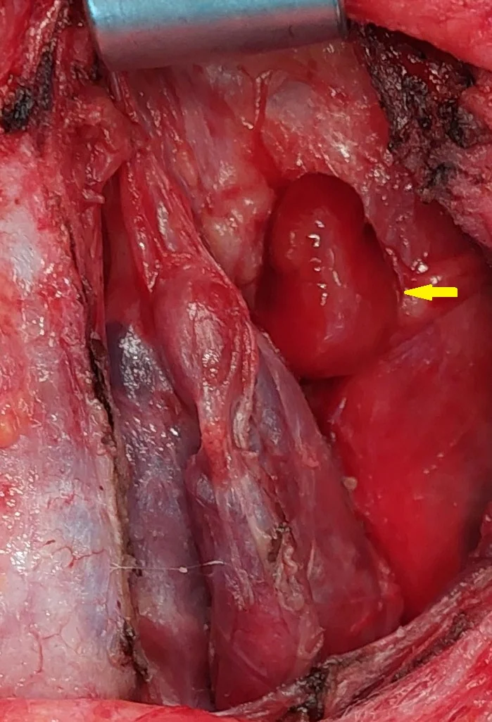 PARATHYROID ADENOMA