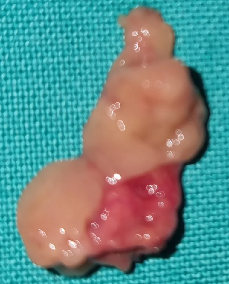PARATHYROID ADENOMA