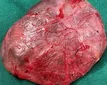 PARATHYROID CYST