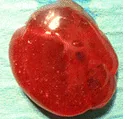 PARATHYROID CYST