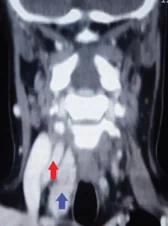 PARATHYROID ADENOMA WITHIN CAROTID SEATH
