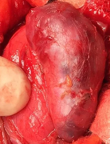 GIANT PARATHYROID ADENOMA