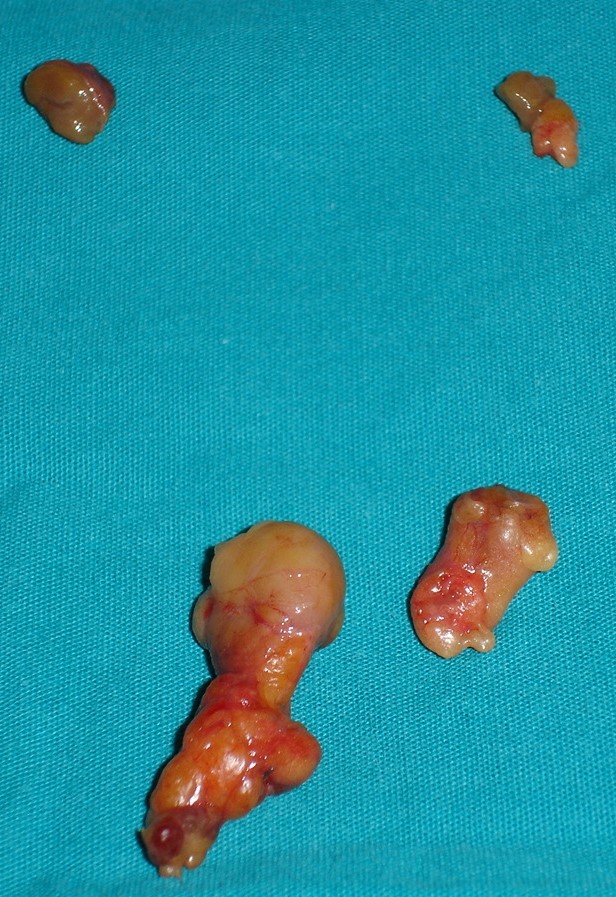 PARATHYROID HYPERPLASIA