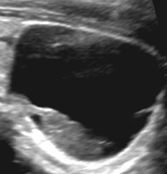 CYSTIC PARATHYROID ADENOMA