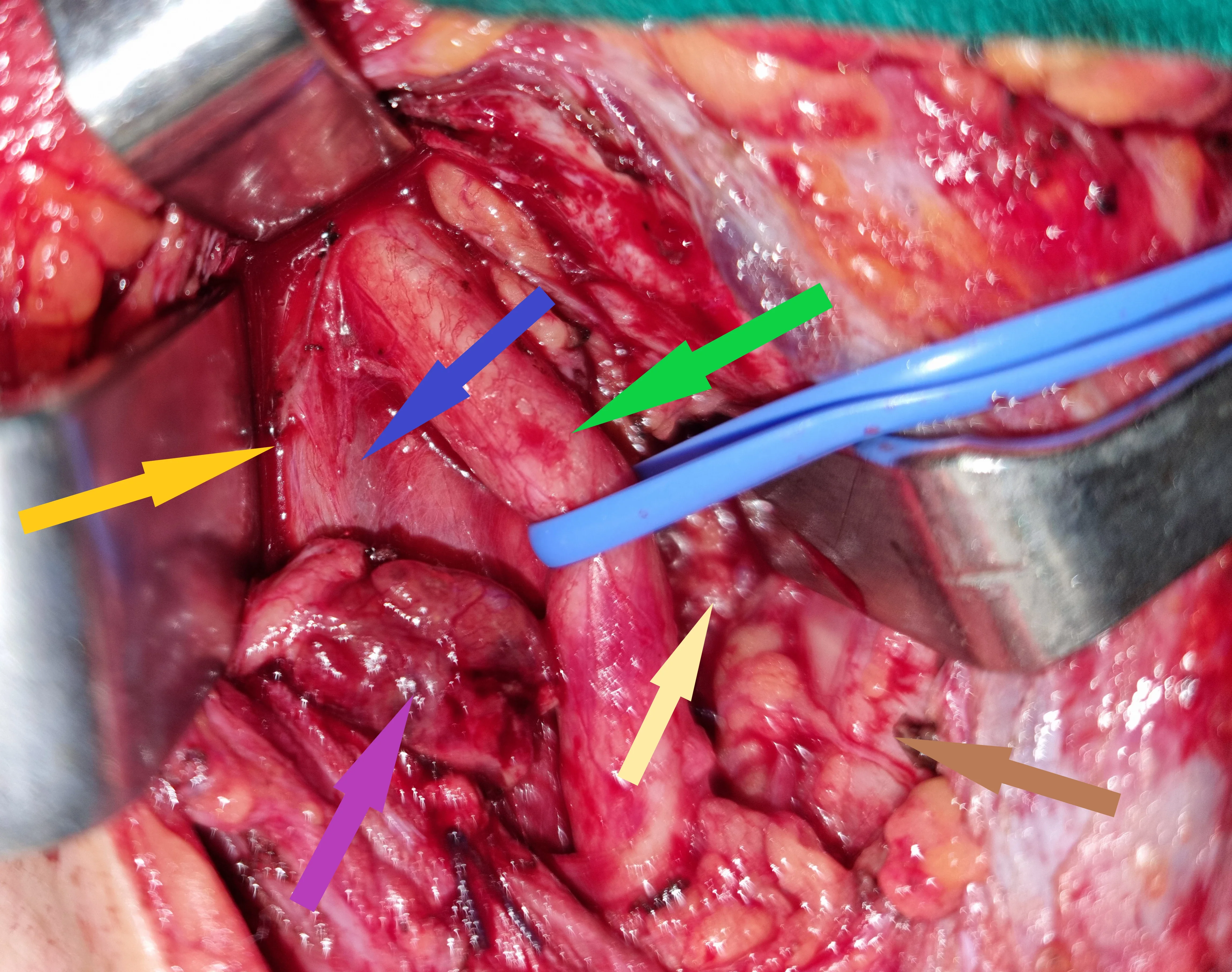 PARATHYROID ADENOMA WITHIN CAROTID SEATH