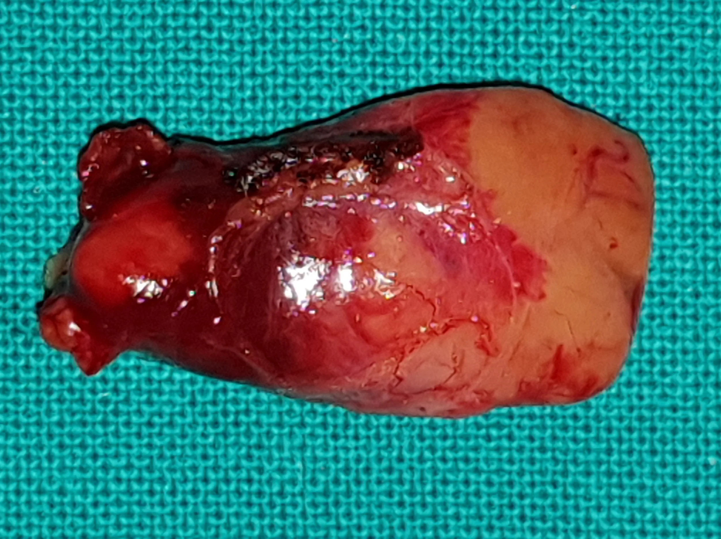PARATHYROID ADENOMA
