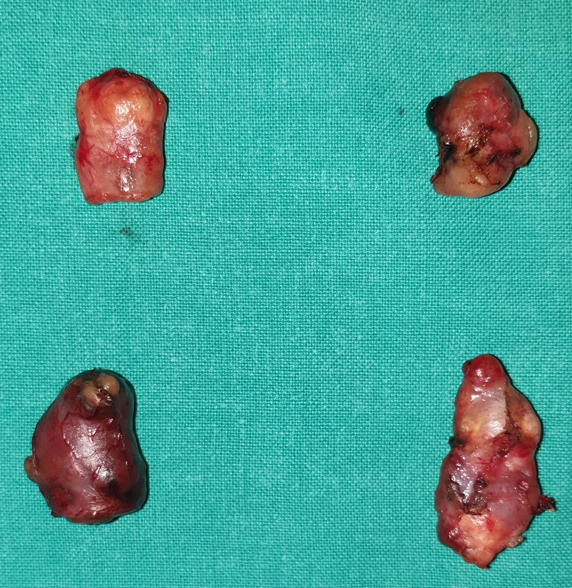 PARATHYROID HYPERPLASIA