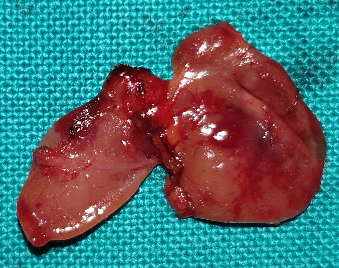 PARATHYROID ADENOMA