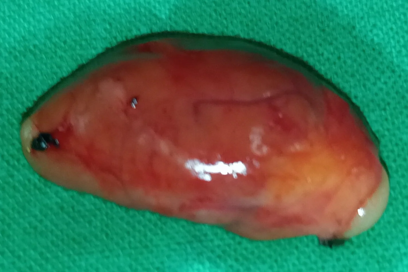 CYSTIC PARATHYROID ADENOMA
