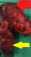 PARATHYROID ADENOMA WITHIN THYROID LOBECTOMY SPECIMEN