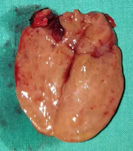 GIANT PARATHYROID ADENOMA