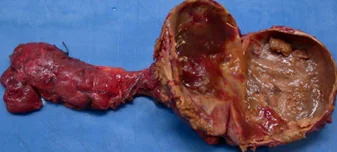 PARATHYROID CYST