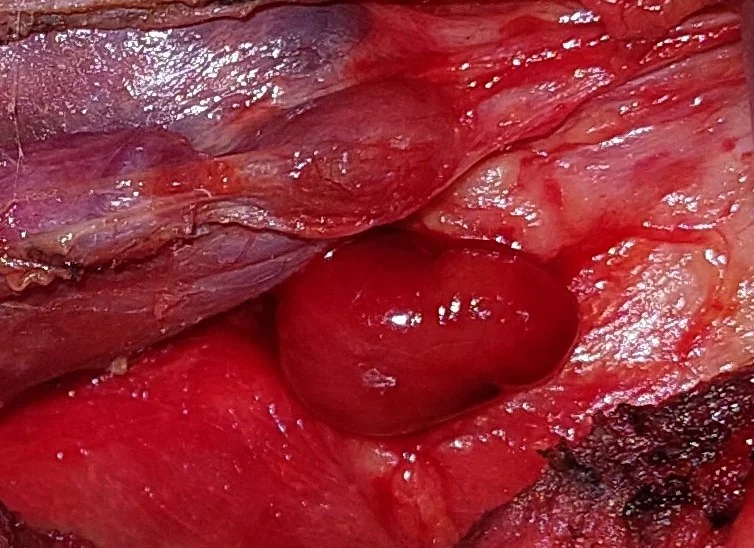 PARATHYROID ADENOMA - OPERATIVE IMAGE