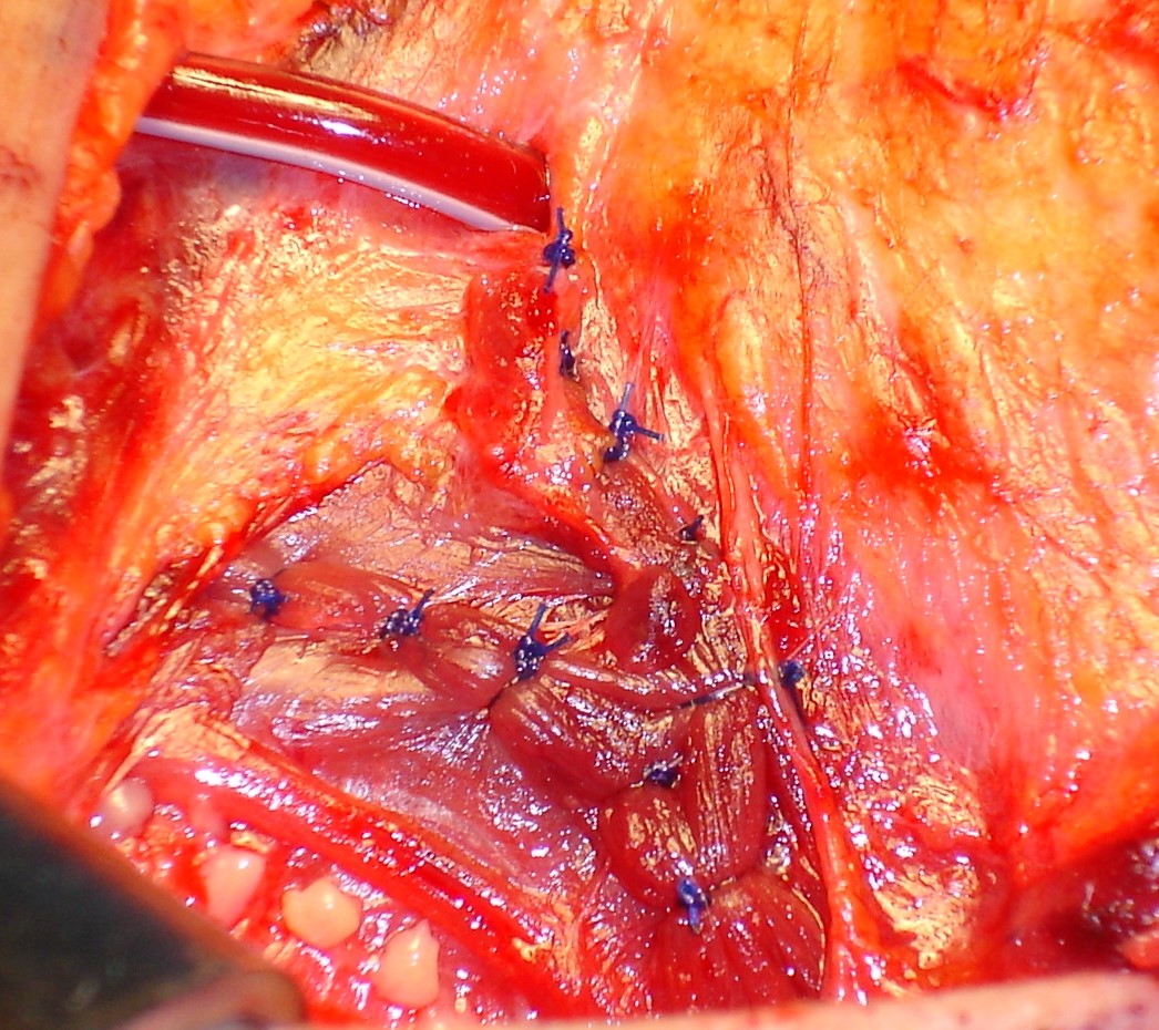 PARATHYROID AUTOTRANSPLANTATION