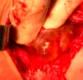 CYSTIC PARATHYROID ADENOMA