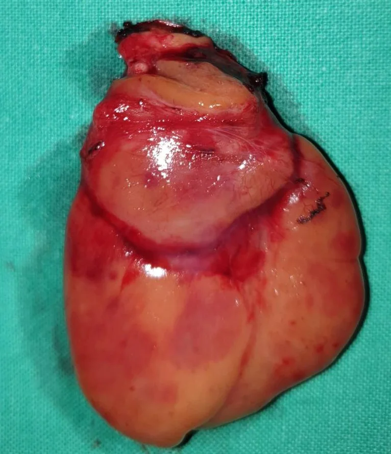 GIANT PARATHYROID ADENOMA