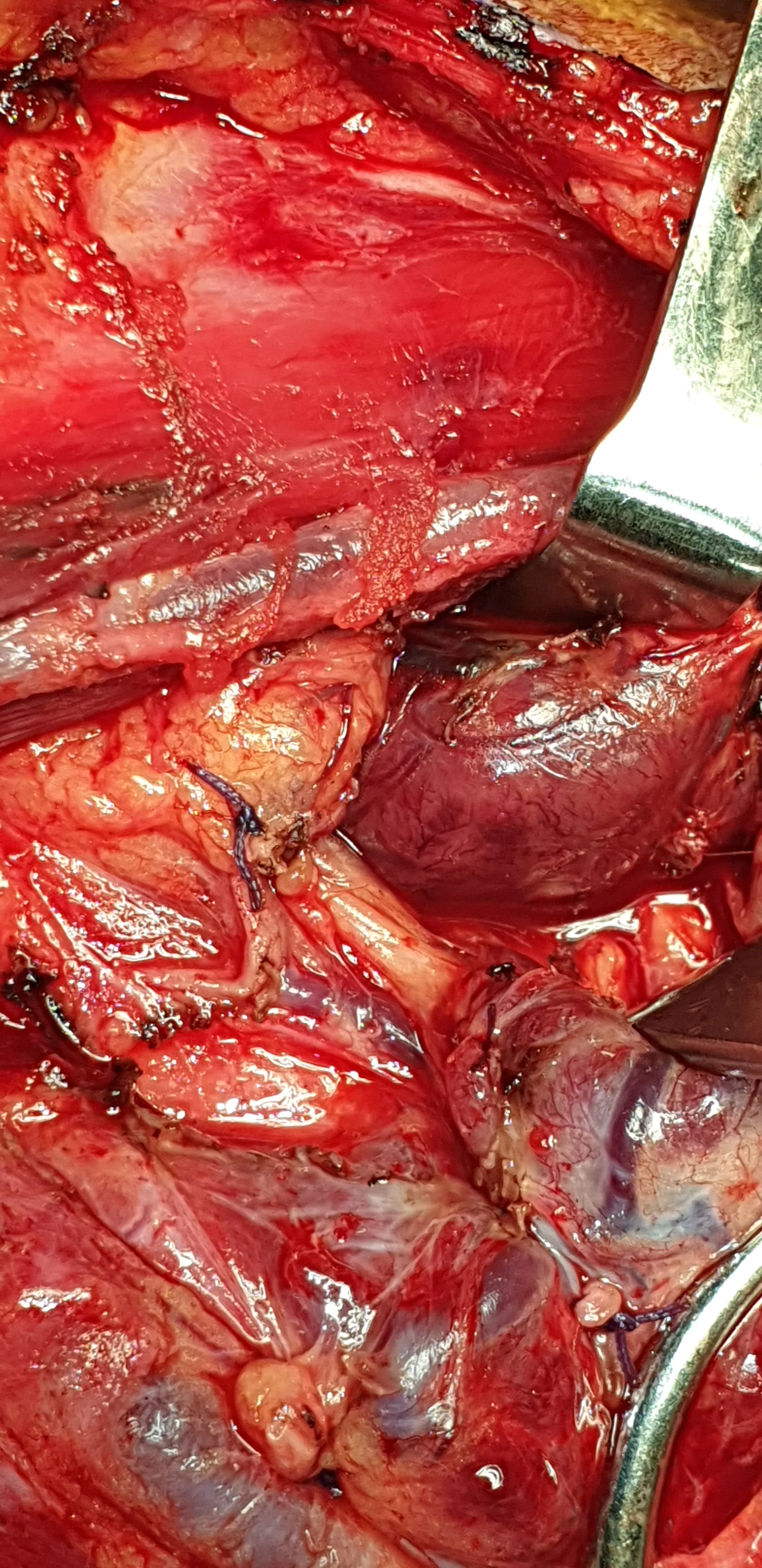 GIANT PARATHYROID ADENOMA