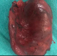 PARATHYROID ADENOMA