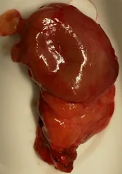 PARATHYROID ADENOMA
