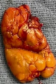PARATHYROID ADENOMA