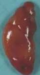 PARATHYROID ADENOMA