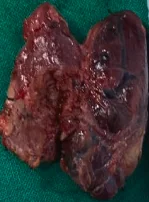 PARATHYROID ADENOMA