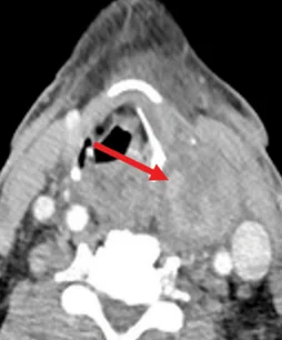 SIZEABLE PARATHYROID ADENOMA