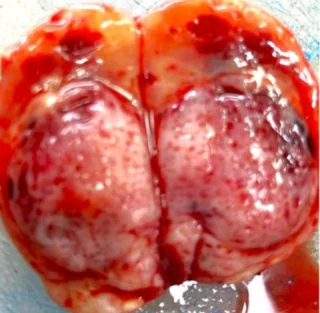 PARATHYROID ADENOMA