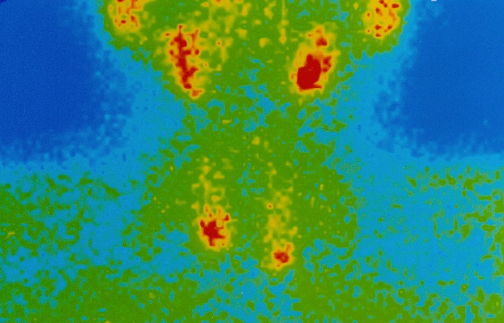 SESTAMIBI SCAN - PARATHYROID ADENOMAS