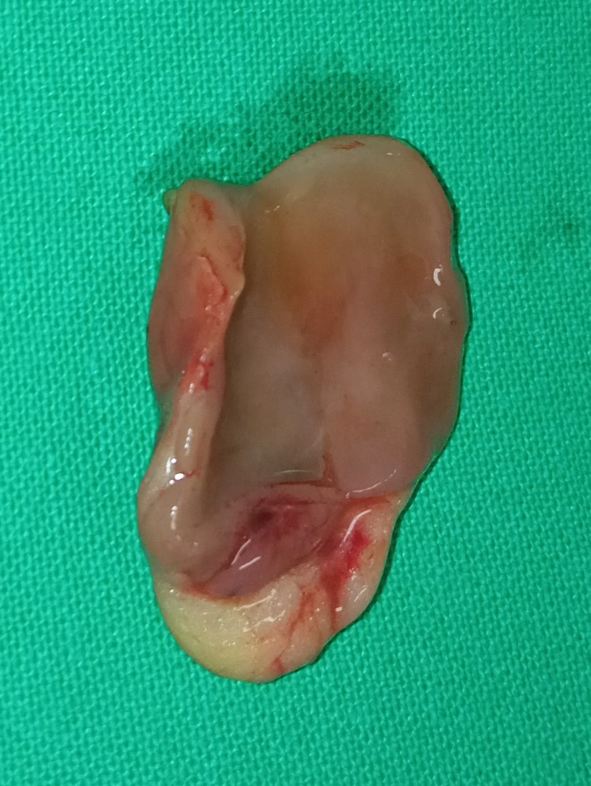 CYSTIC PARATHYROID ADENOMA