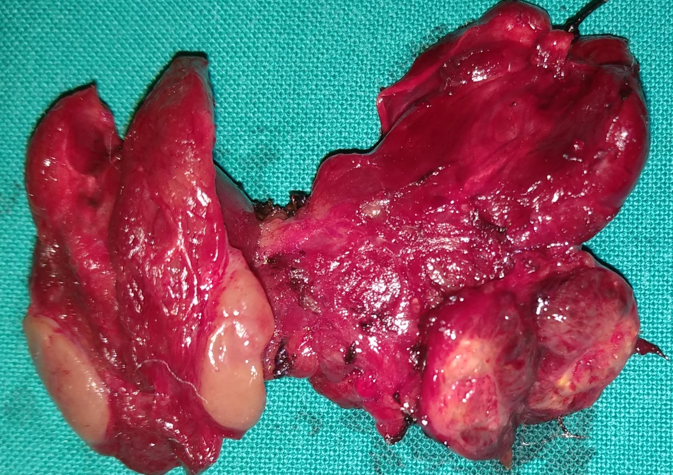 DOUBLE PARATHYROID ADENOMAS