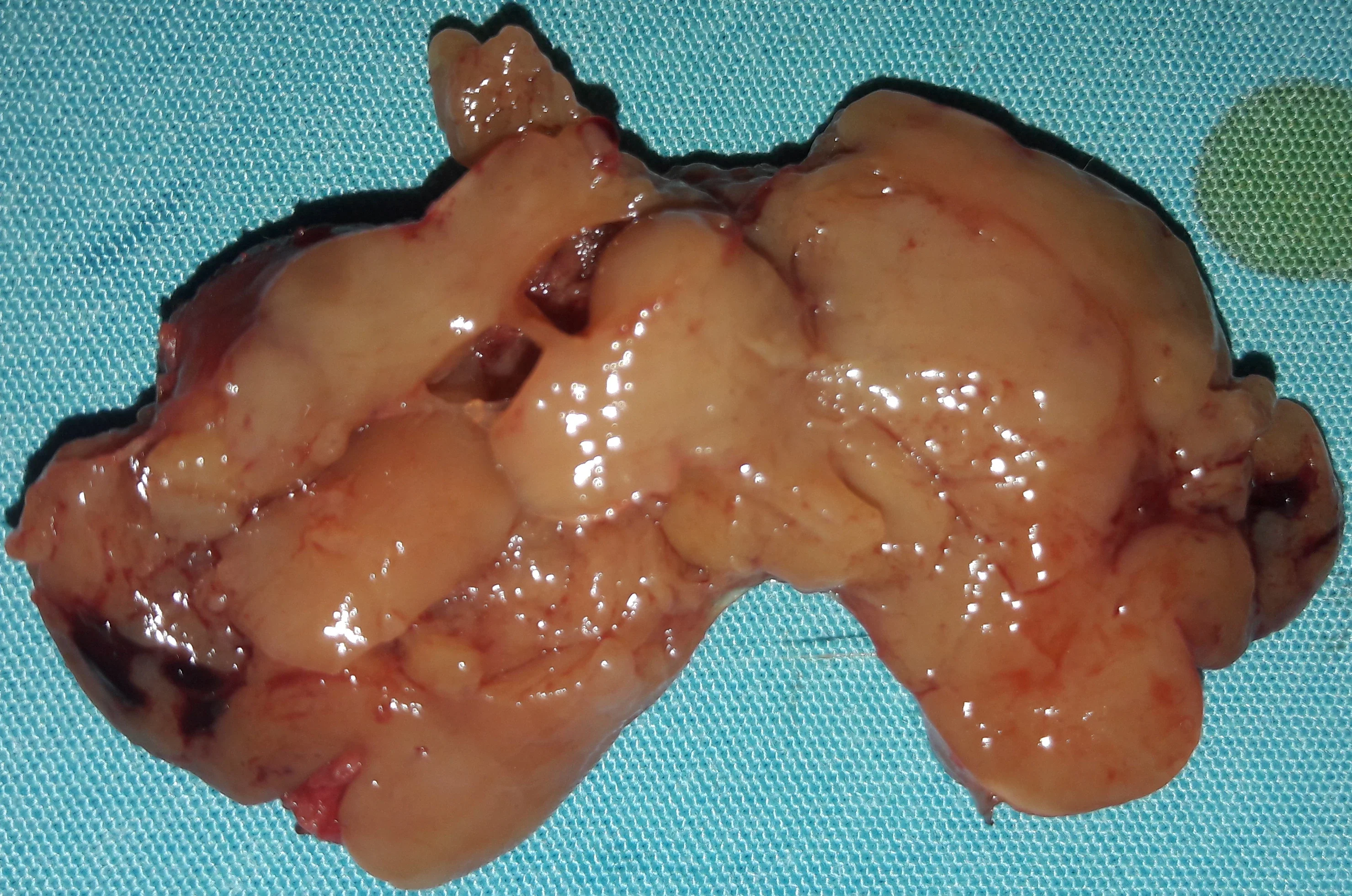 GIANT PARATHYROID ADENOMA