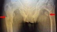 HUNGRY BONE SYNDROME