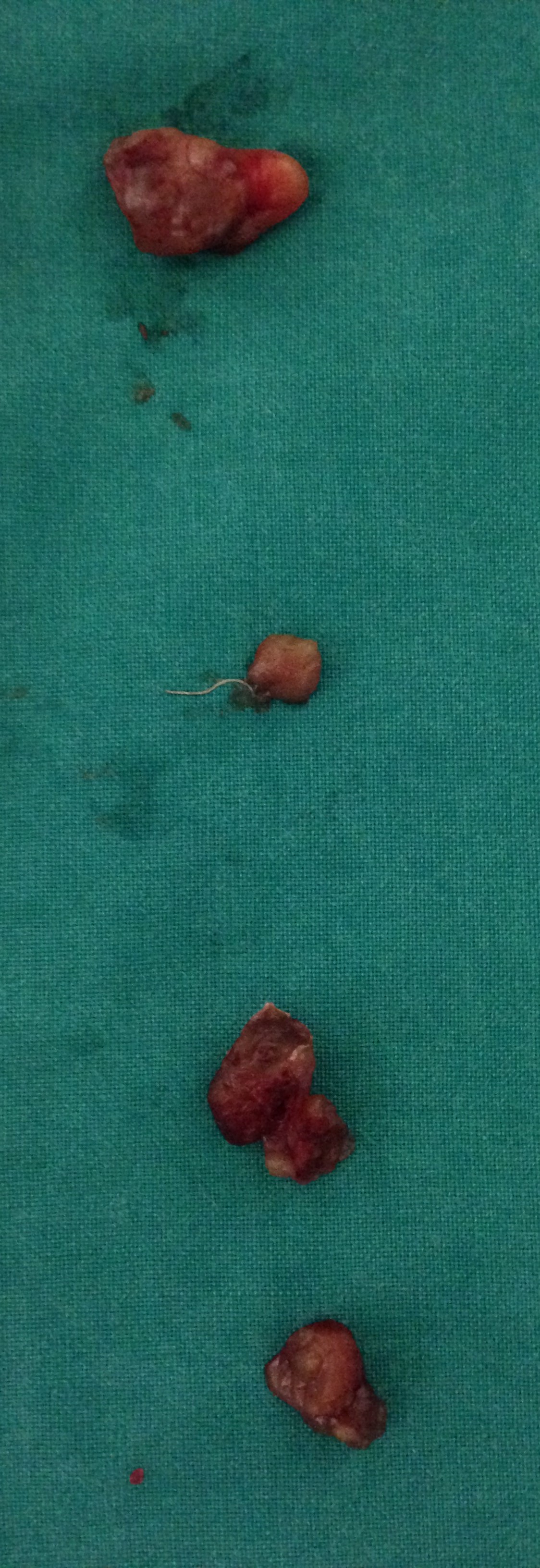PARATHYROID HYPERPLASIA