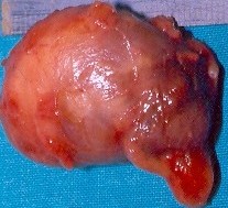 PARATHYROID CARCINOMA